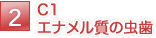 C1 エナメル質の虫歯