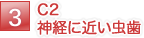 C2 神経に近い虫歯