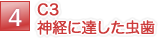 C3 神経に達した虫歯